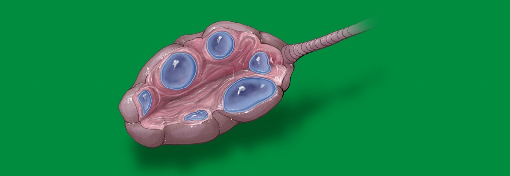 Polycystic Ovary on Green, short, background