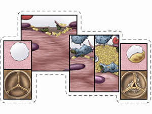 A series of images depicting calcific aortic stenosis progression including lipid and platelet buildup and macrophage involvement.